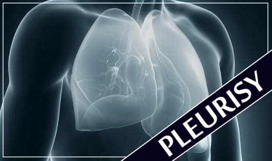 Pleurisy
