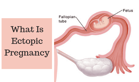 What Is Ectopic Pregnancy?