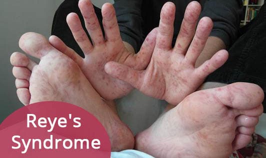 Reye's Syndrome