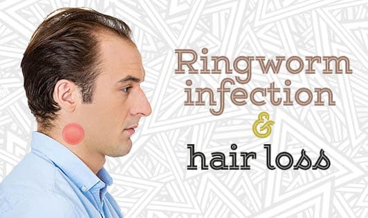 Ringworm infection & hair loss 