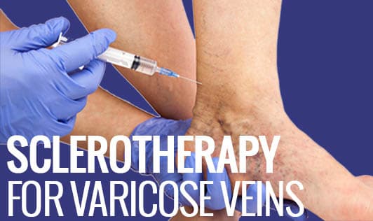 Sclerotherapy for varicose veins