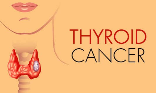 Thyroid Cancer
