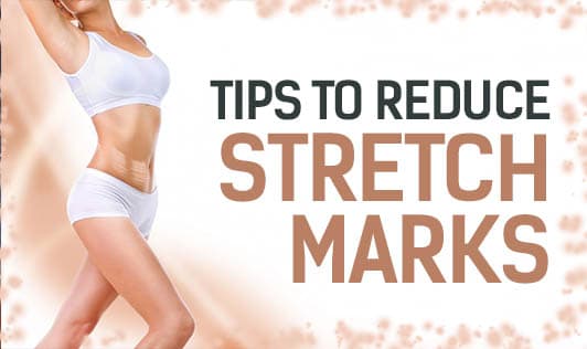 Tips to Reduce Stretch Marks