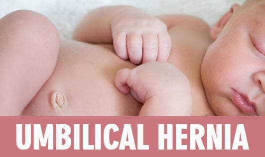 Umbilical Hernia