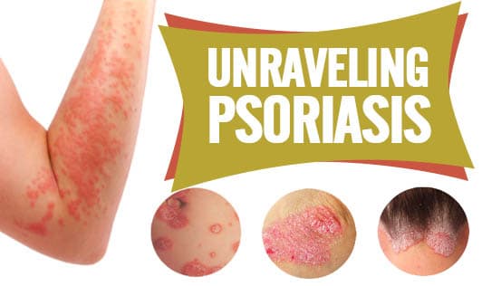 Unraveling Psoriasis