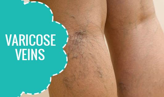 Varicose Veins
