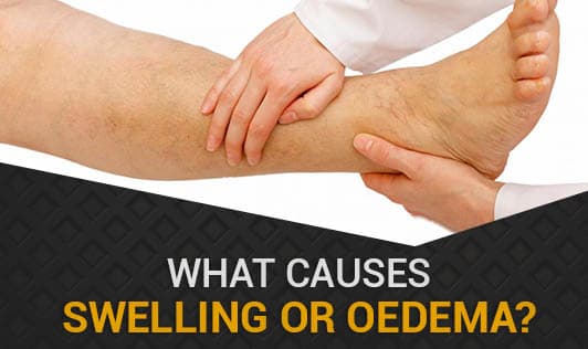 What Causes Swelling or Oedema?
