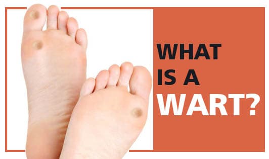 What Is A Wart?