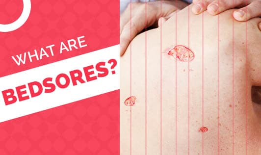What are Bedsores?