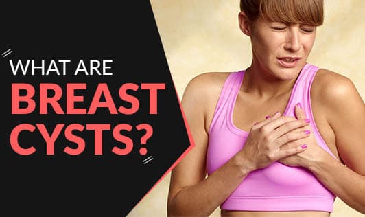 What are breast cysts?