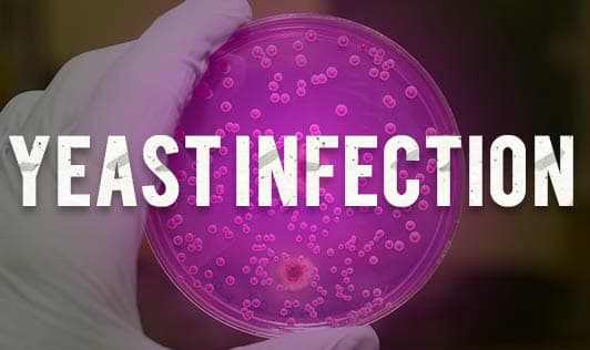 Yeast Infection