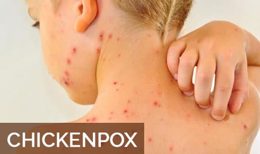 Chickenpox