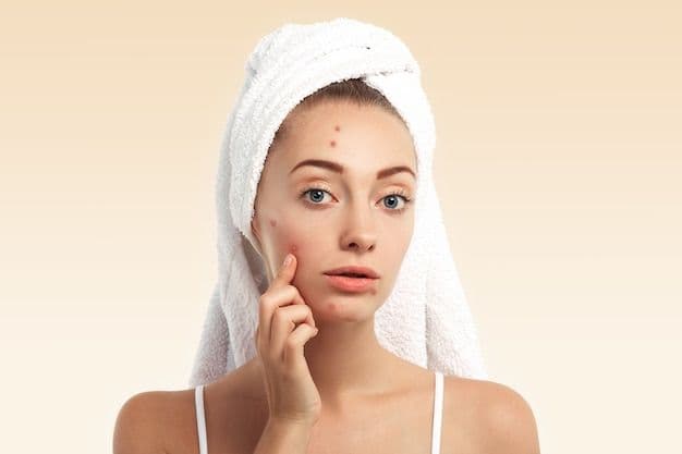 Debunk Those Age-Old Myths About Pimples!