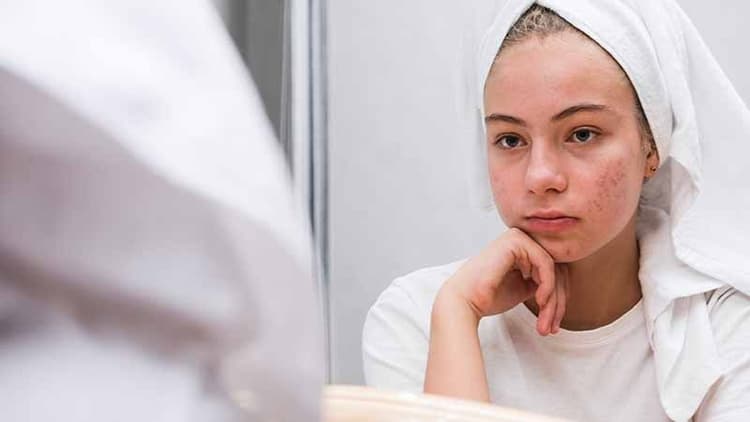 Acne Got You Feeling Down? Ways To Boost Your Self-Esteem And Be Less Self-Conscious
