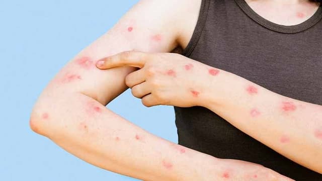 monkeypox-virus-outbreak