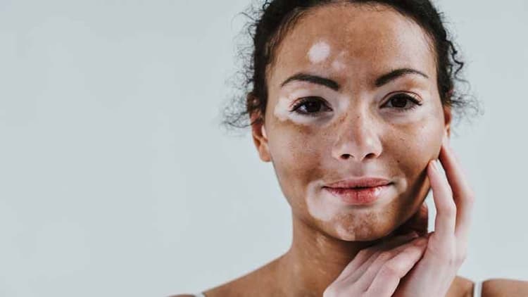 Vitiligo