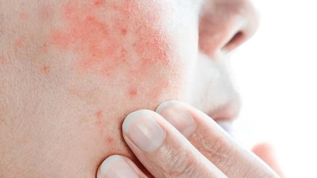 winter-rash