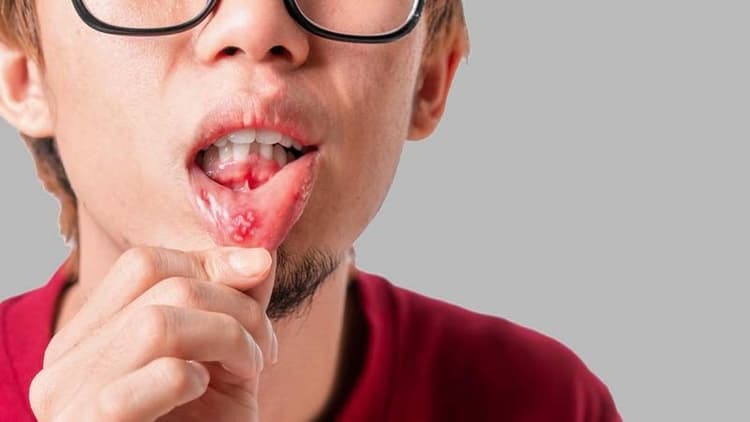 Sick of Mouth Sores? Here’s How to Manage & Prevent Them