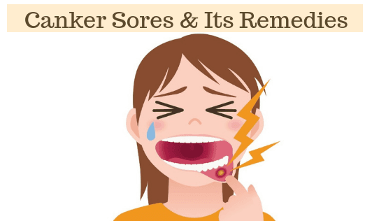 Canker Sores & It's Remedies