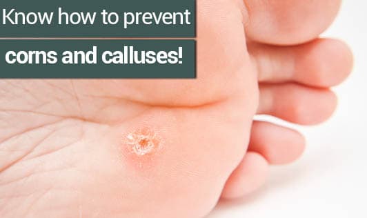 Know how to prevent corns and calluses!