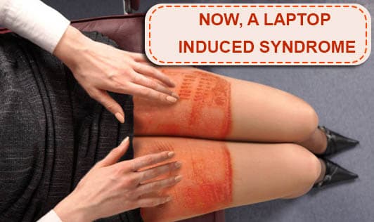 NOW, A LAPTOP INDUCED SYNDROME