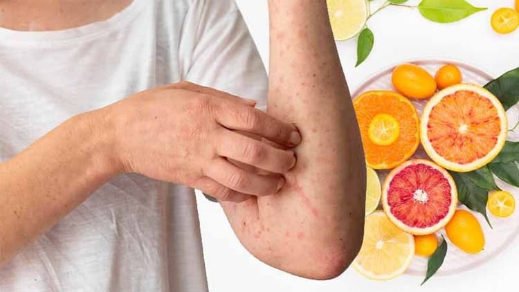 Fighting Measles the diet way