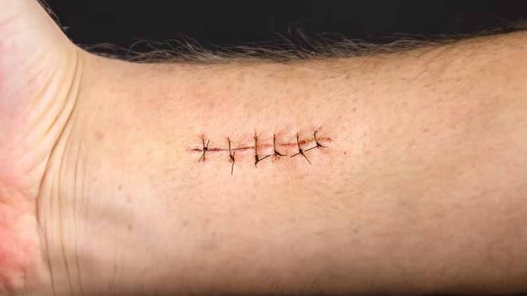 What Are Dissolvable Stitches? Who Are They Beneficial To? - The Wellness Corner What Are Dissolvable Stitches? Who Are They Beneficial To? - The Wellness Corner