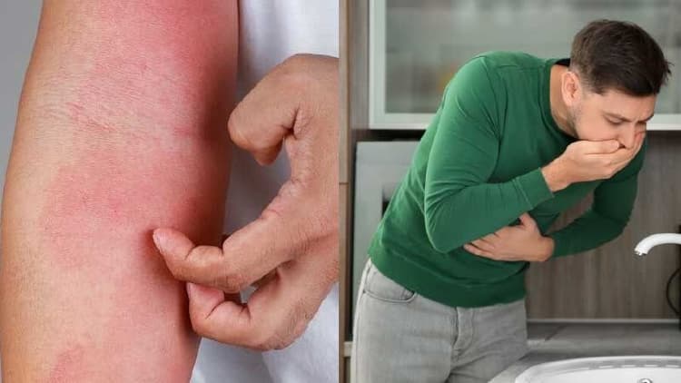 Food Allergy Vs. Food Intolerance: Understanding The Differences