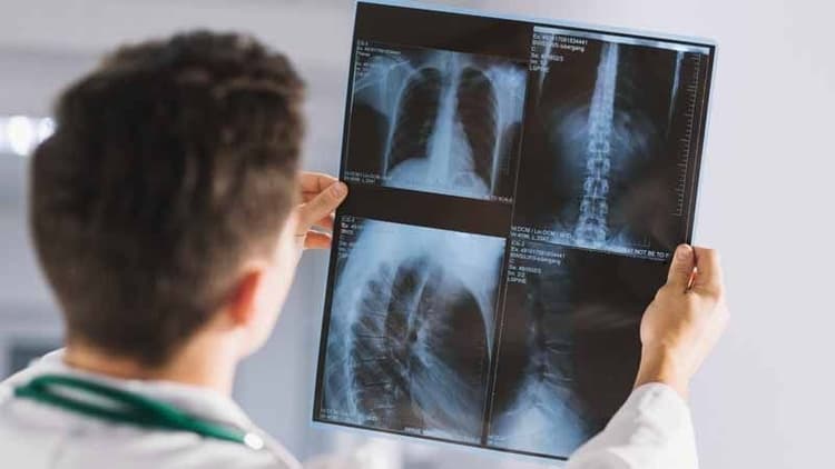 Bone Density Test - Who Needs It & Why