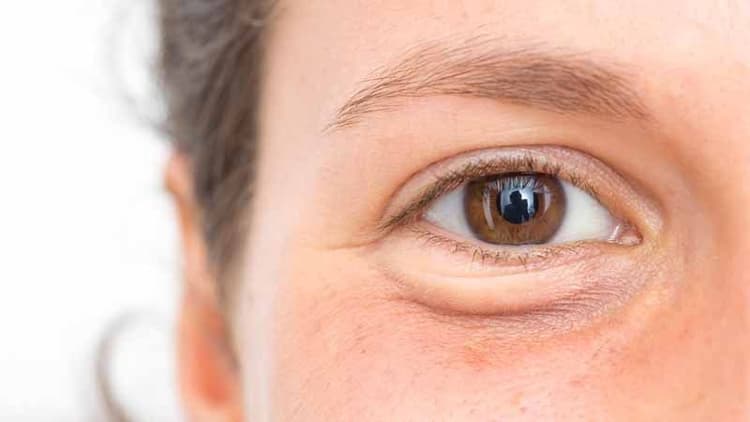 How To Get Rid Of Puffy Eyes: Effective Tips And Remedies