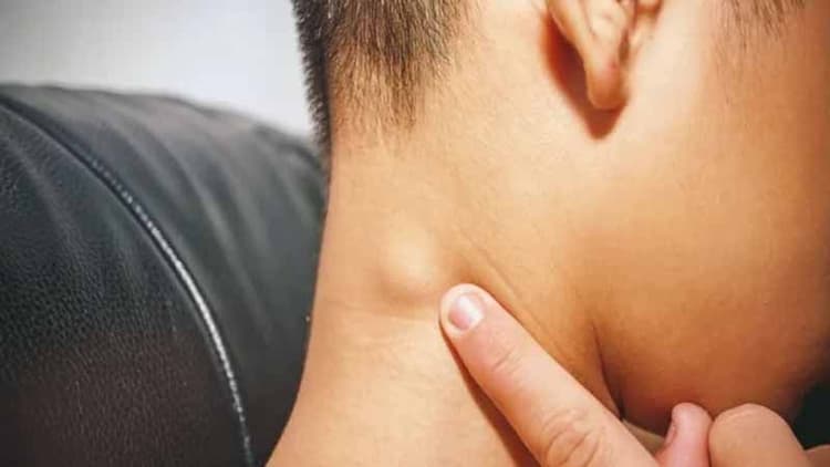 Reduce the Risk of Lymphoma