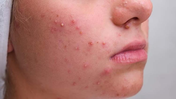 9 Things To Try When Acne Won’t Clear