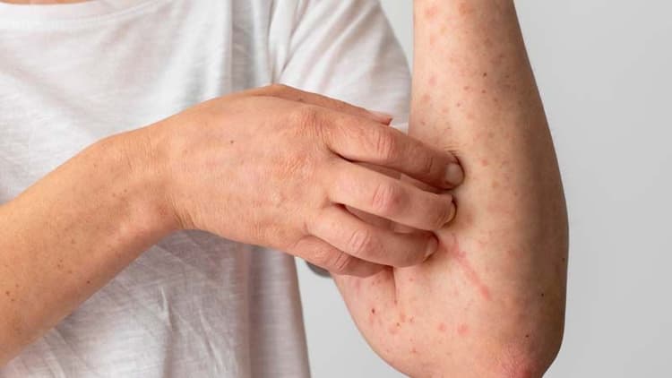 6 Expert-Backed Tips For Staying Acne-Free After Waxing