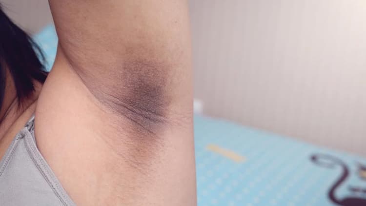 Dark Underarms Could Be A Health Warning Sign — Not Just A Beauty Issue
