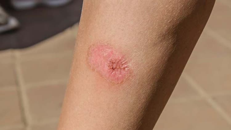 How To Control Bed Sores At Home?